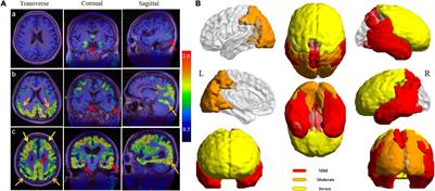 18F-APN-1607 Tau Positron Emission Tomography Imaging for Evaluating Disease Progression in Alzheimer’s Disease